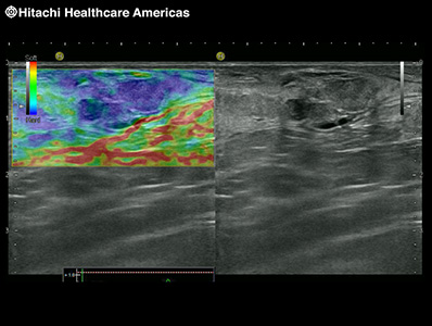 Real-time Tissue Elastography (RTE)