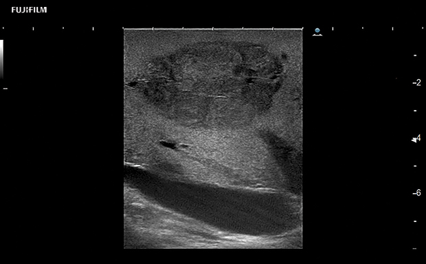 Liver Surgery Procedure using L46K1
