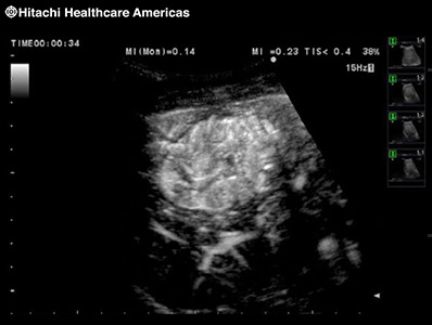 Contrast Harmonic Imaging (CHI) *