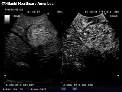 Contrast Harmonic Imaging (CHI)