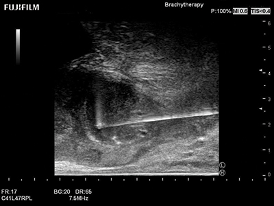 Transperineal Biopsy using the C41L47RP Transducer