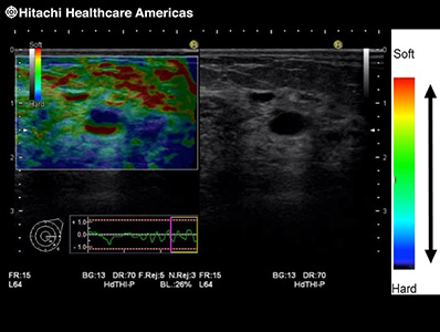 Real Time Elastography