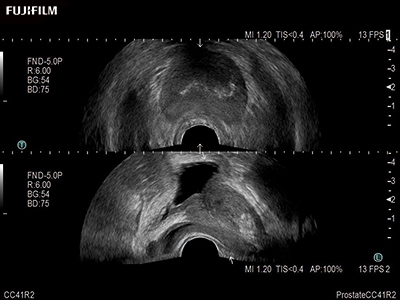Prostate Imaging using the CC41R2 Transducer