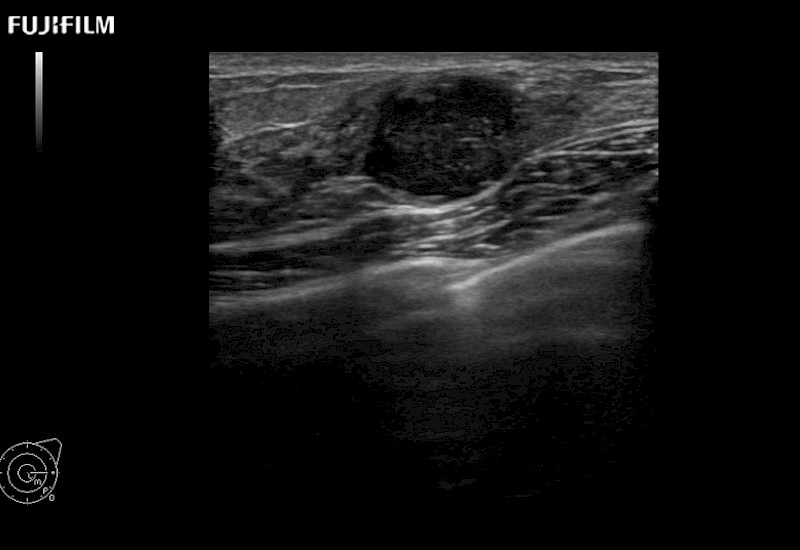 Breast Lesion