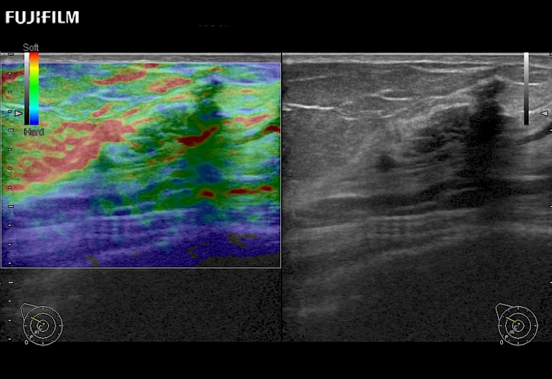 Breast Lesion Elastography