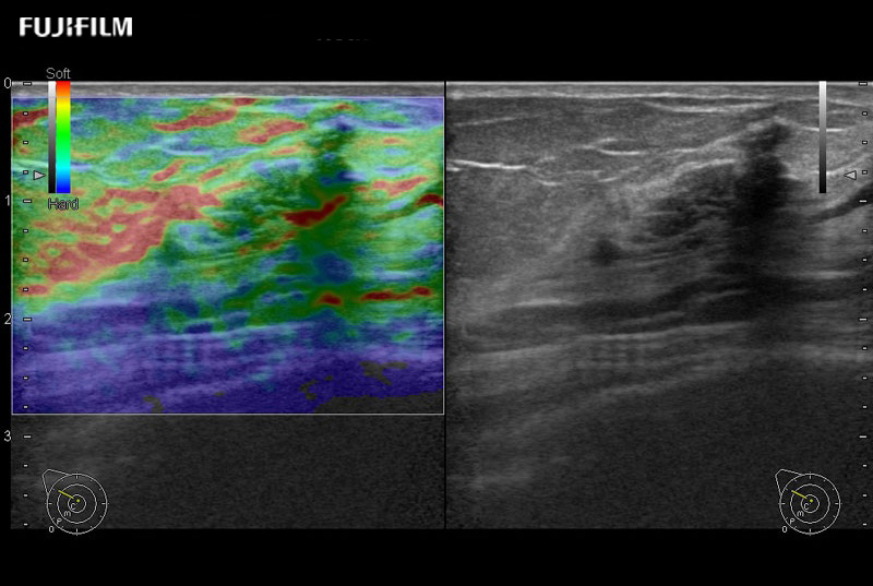 Breast Lesion Elastography