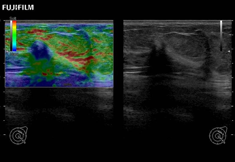 Breast Lesion Elastography