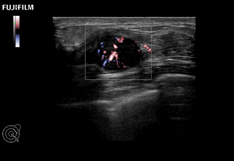 Breast Lesion eFlow