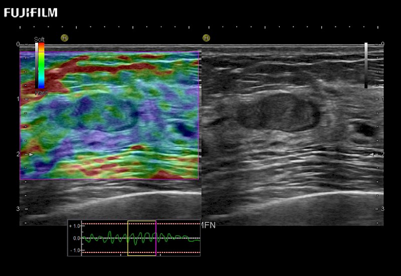 Breast Solid Lesion Elastography