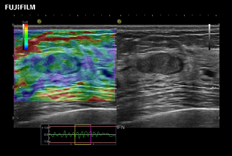 Breast Solid Lesion Elastography