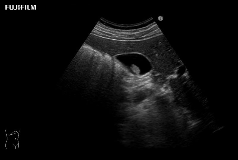 Gall Bladder NonShadowing Stone