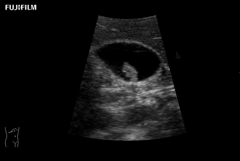 Gall Bladder NonShadowing Stone Zoom