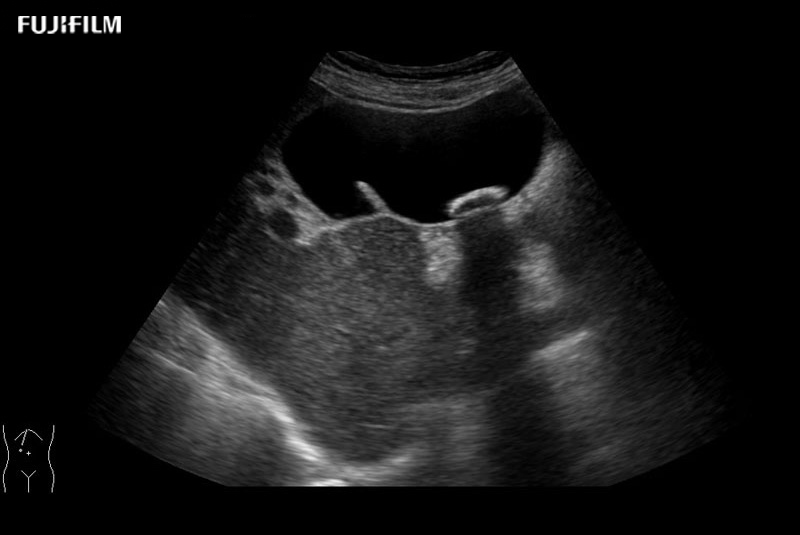 Gall Bladder Shadowing Stone