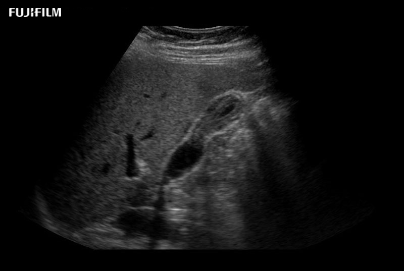 Gall Bladder Thickened Wall