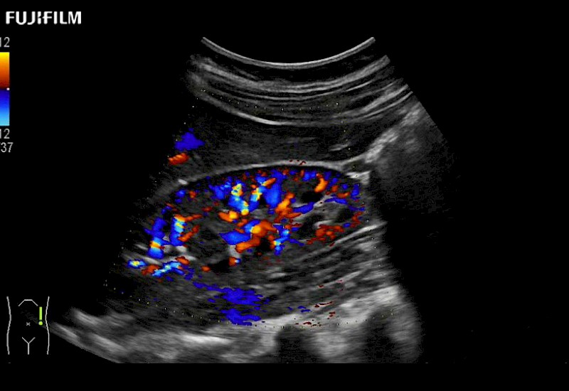 Kidney Doppler