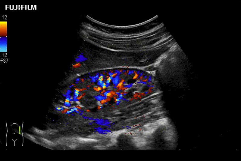 Kidney Doppler