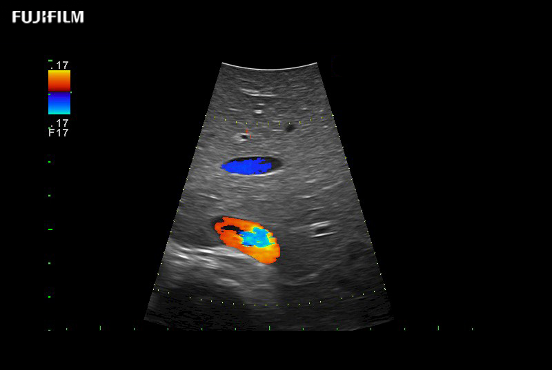 Liver Color Doppler