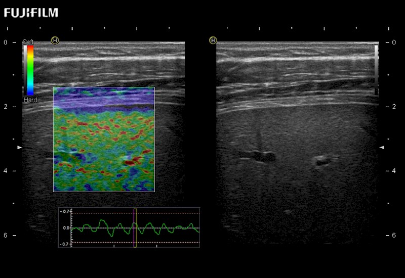 Liver Elastography