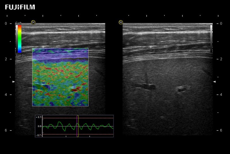 Liver Elastography