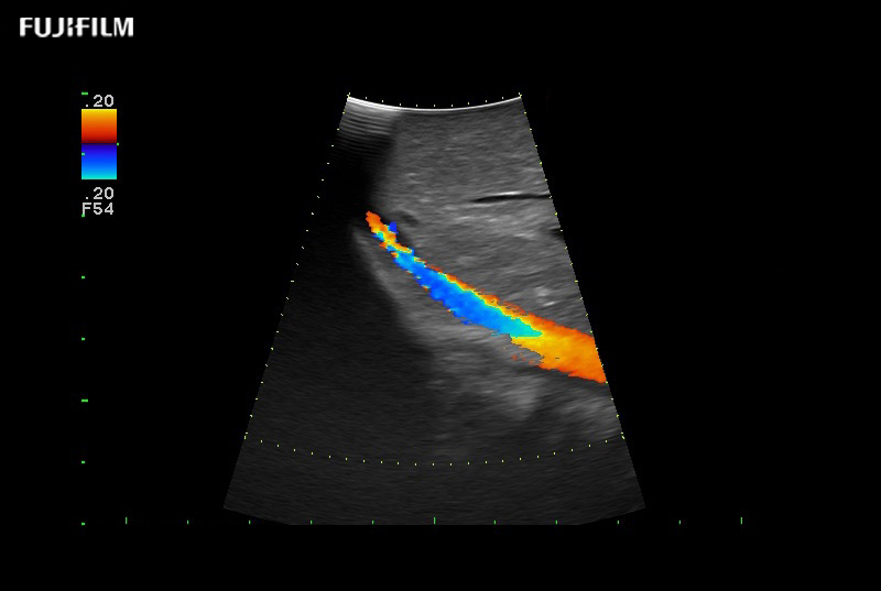 Liver Color Doppler