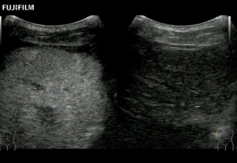 Liver Lesion Contrast