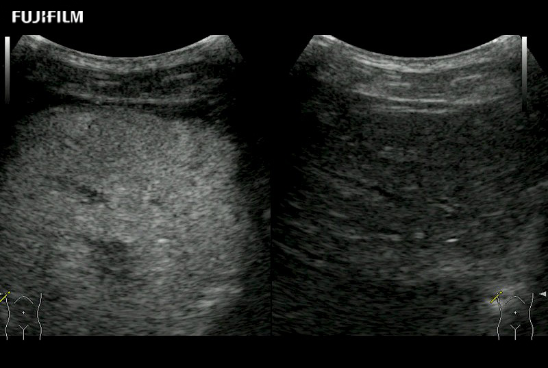 Liver Lesion Contrast