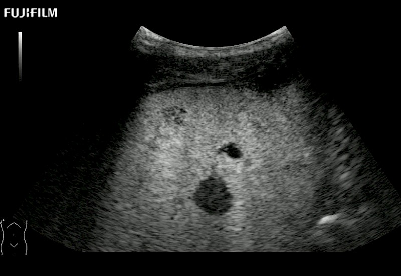 Liver Lesion Contrast