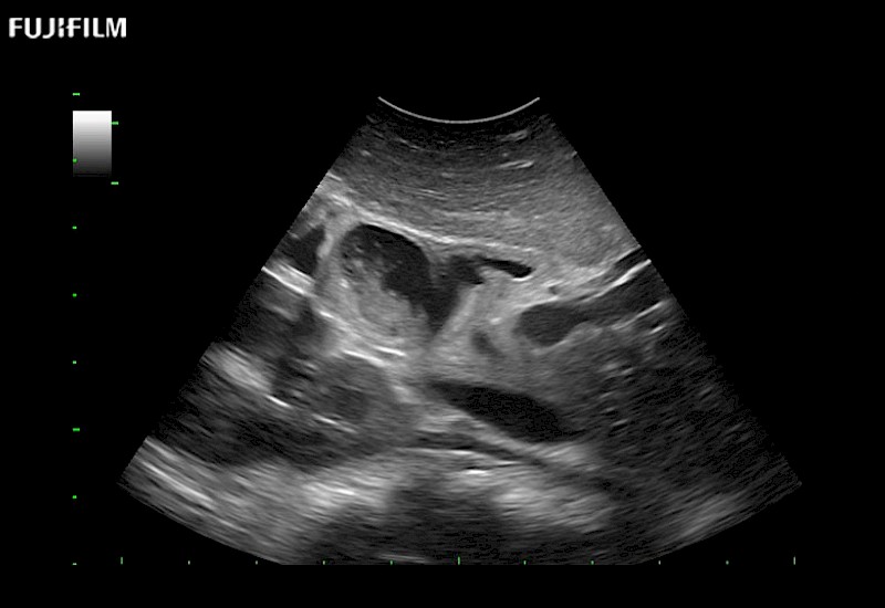 Pancreatic Mass