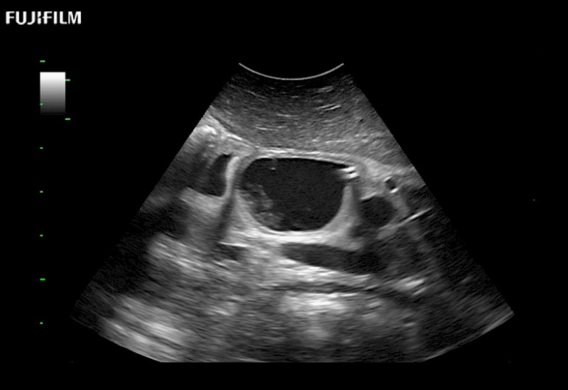 Pancreatic Mass