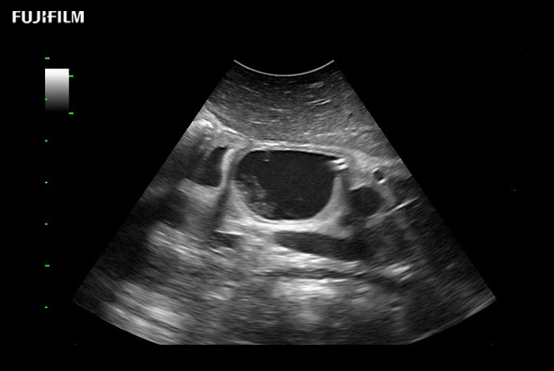 Pancreatic Mass