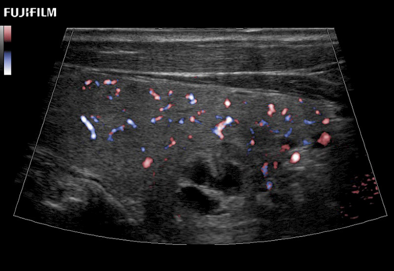 Thyroid Trapezoid eFlow