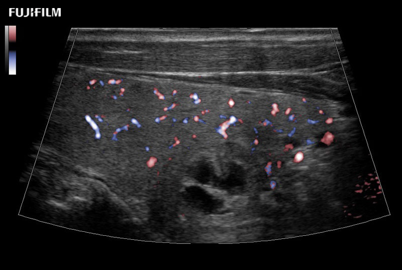 Thyroid Trapezoid eFlow