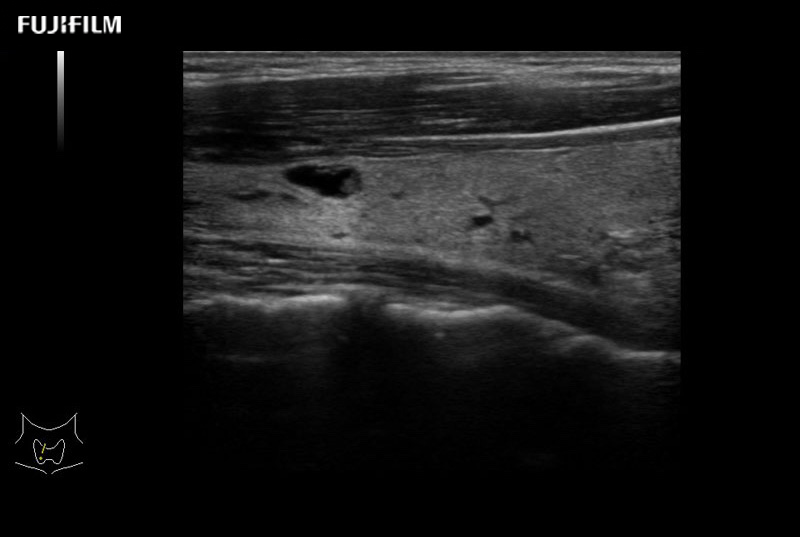 Thyroid Cyst