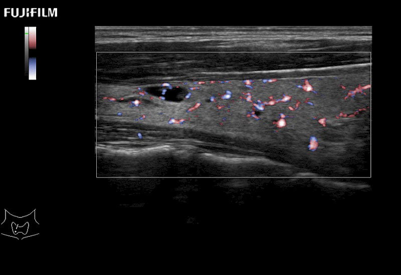 Thyroid Cyst eFlow