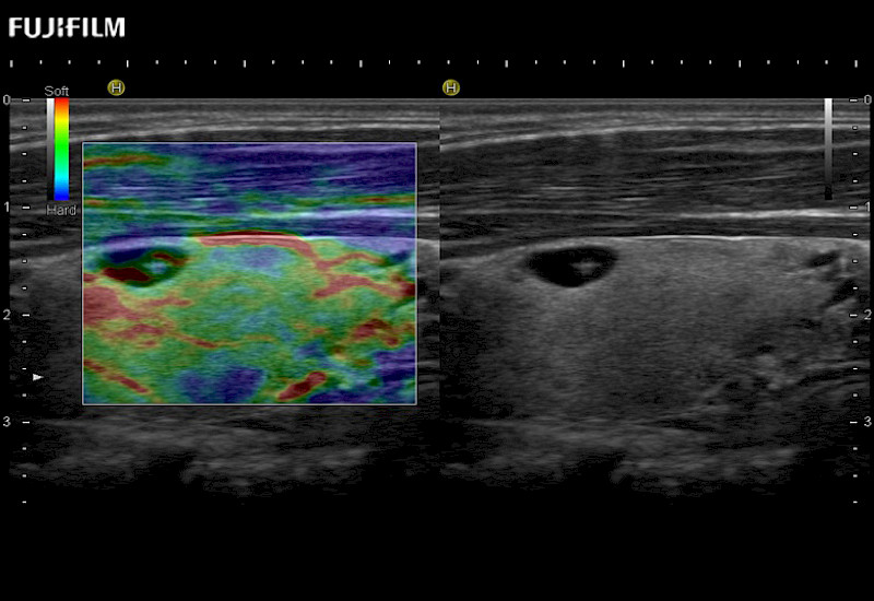 Thyroid Elastography