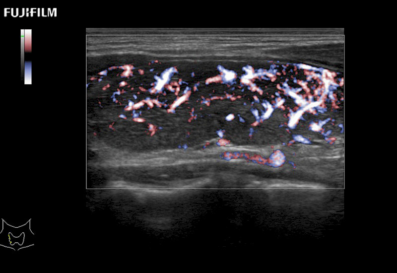 Thyroid eFlow