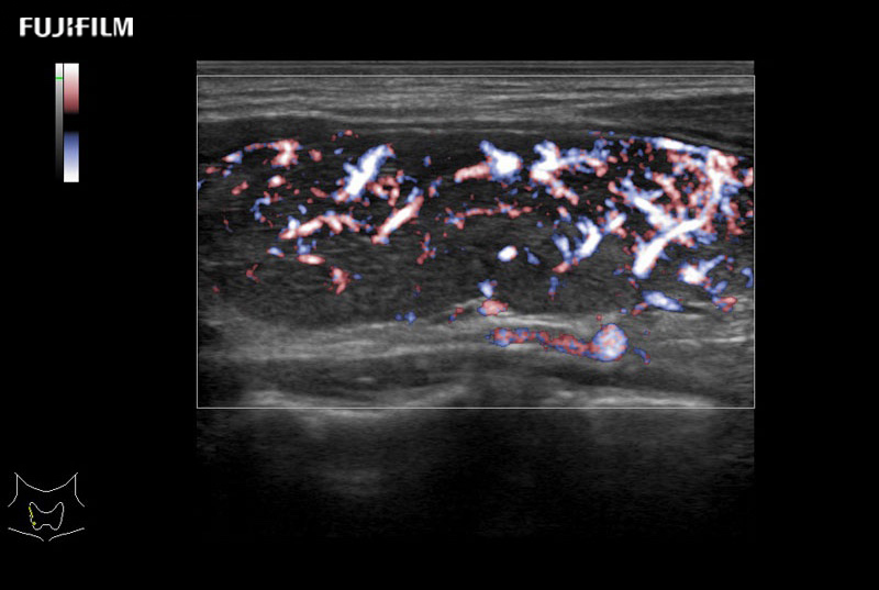 Thyroid eFlow