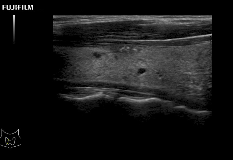 Thyroid Cysts