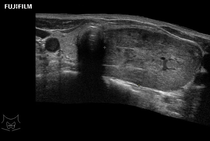 Thyroid Lesion Extended Field of View EFV