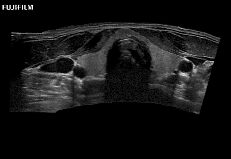 Thyroid Extended Field of View EFV