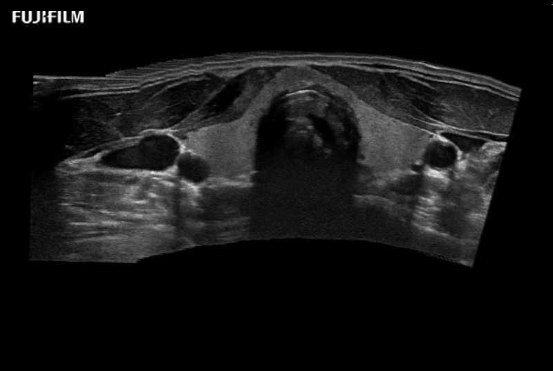 Thyroid Extended Field of View EFV