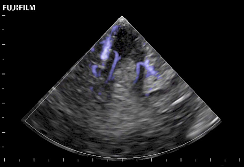 Brain Tumor with Blood Flow