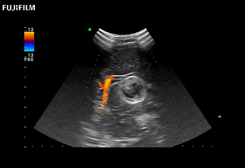 Brain Tumor with Blood Flow