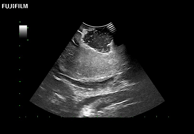 Post Disection Cavity