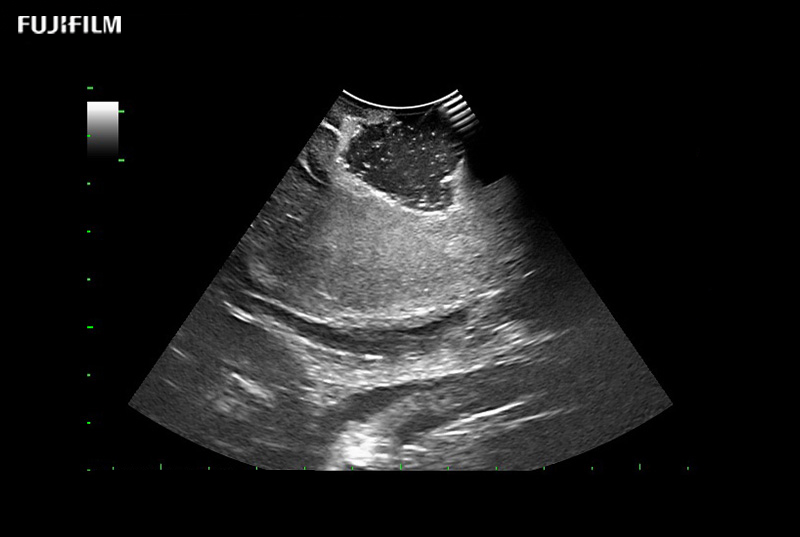 Post Disection Cavity