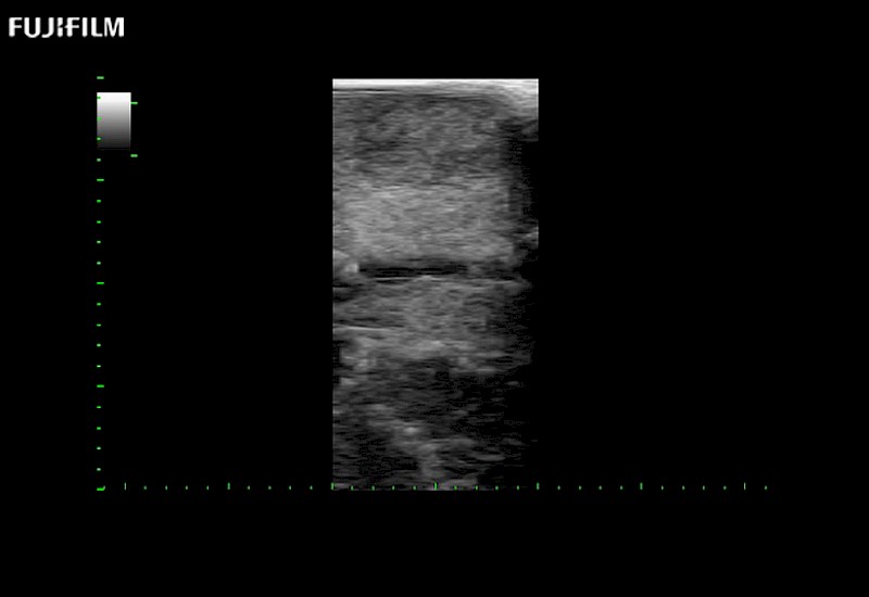 Pituitary Mass