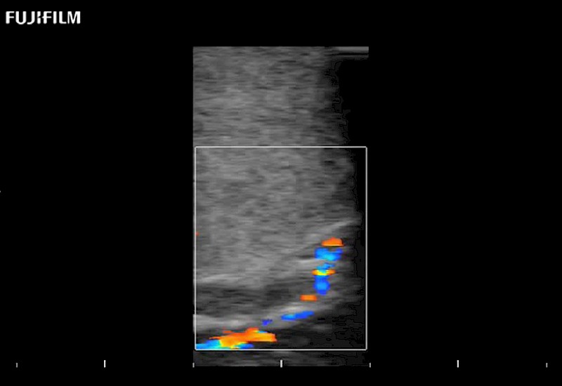 Carotid Flow