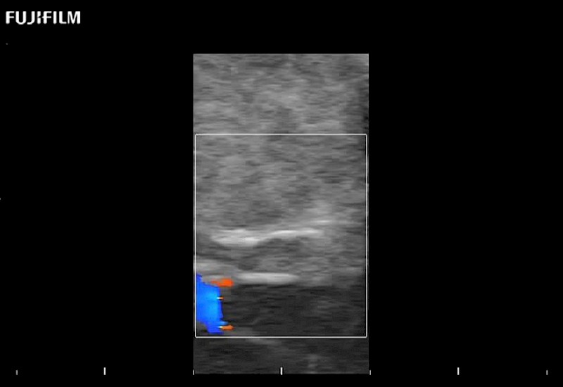 Carotid Flow