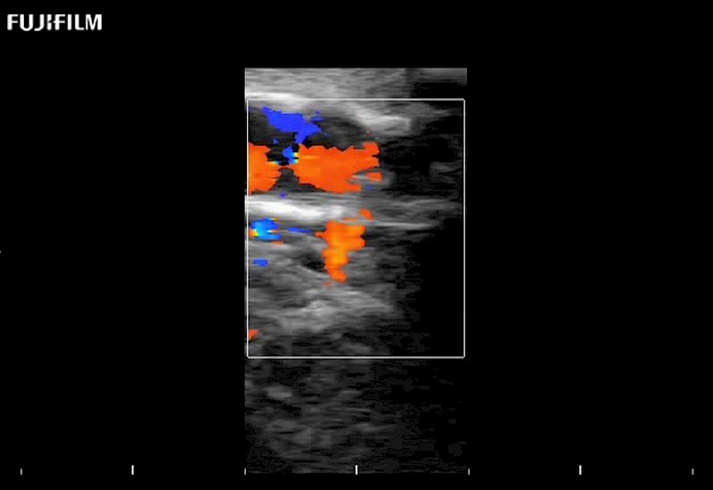 Carotid Flow