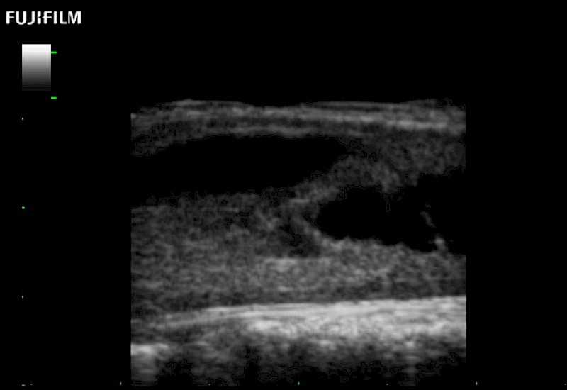 Spinal Cord Complex Tumor of Thoracic Spinal Cord